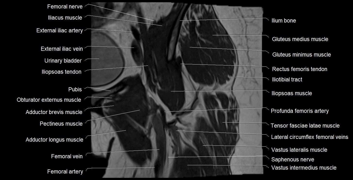 MRI Hip 3T coronal cross sectional anatomy image 17.webp